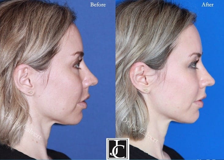 midface lift beverly hills