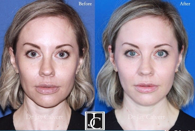 midface lift procedure