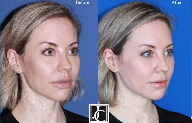 midface lift results